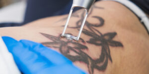 Wedding Day Regret? 5 Reasons to Remove Tattoos Before You Say "I Do"